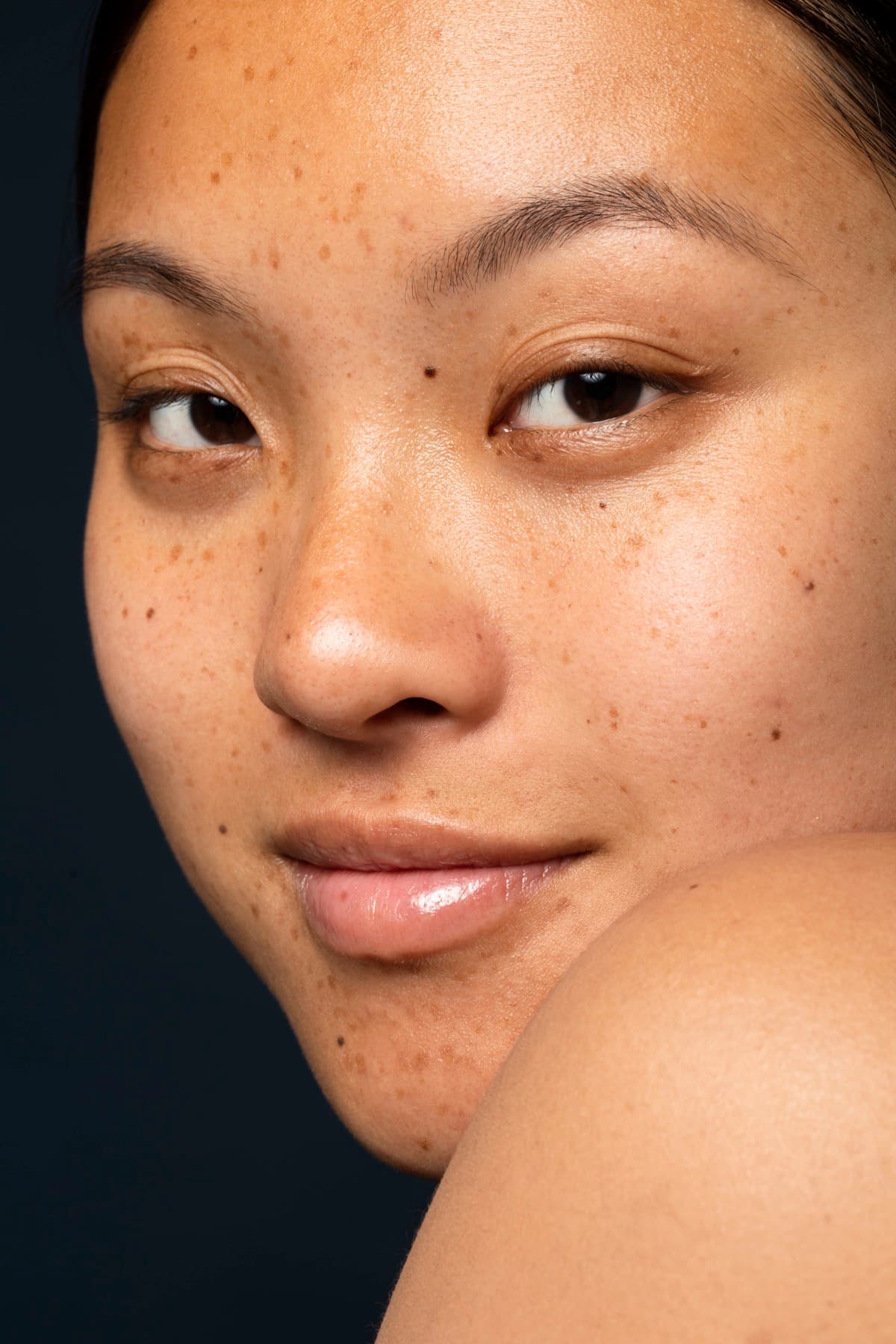 Hyperpigmentation Treatment