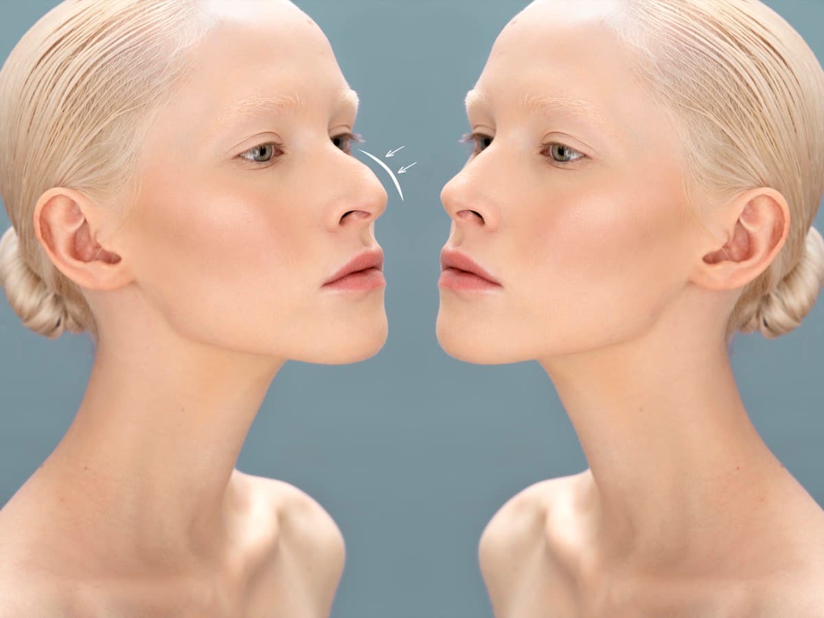 Nonsurgical Rhinoplasty