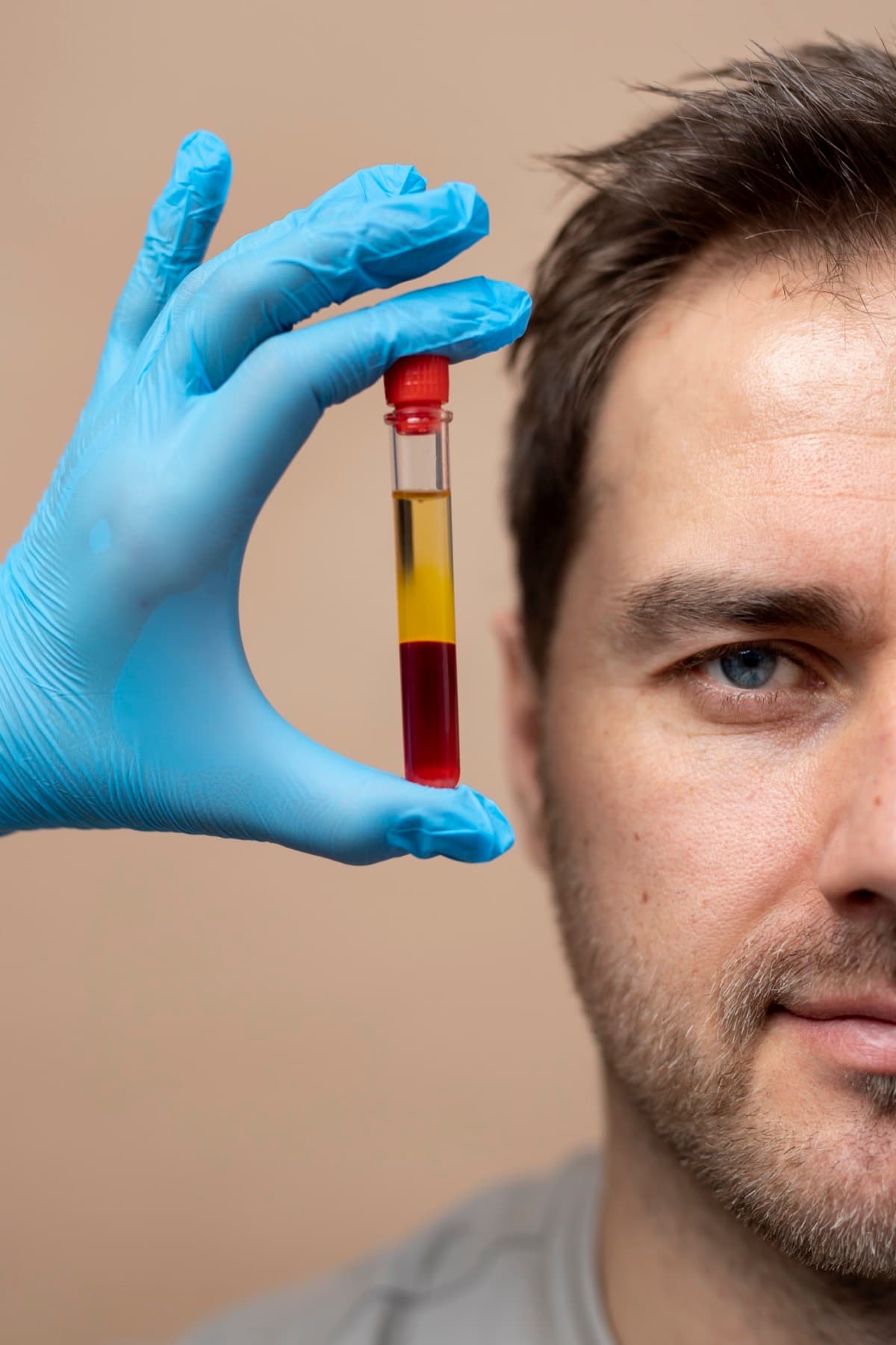 Platelet Rich Plasma (PRP)