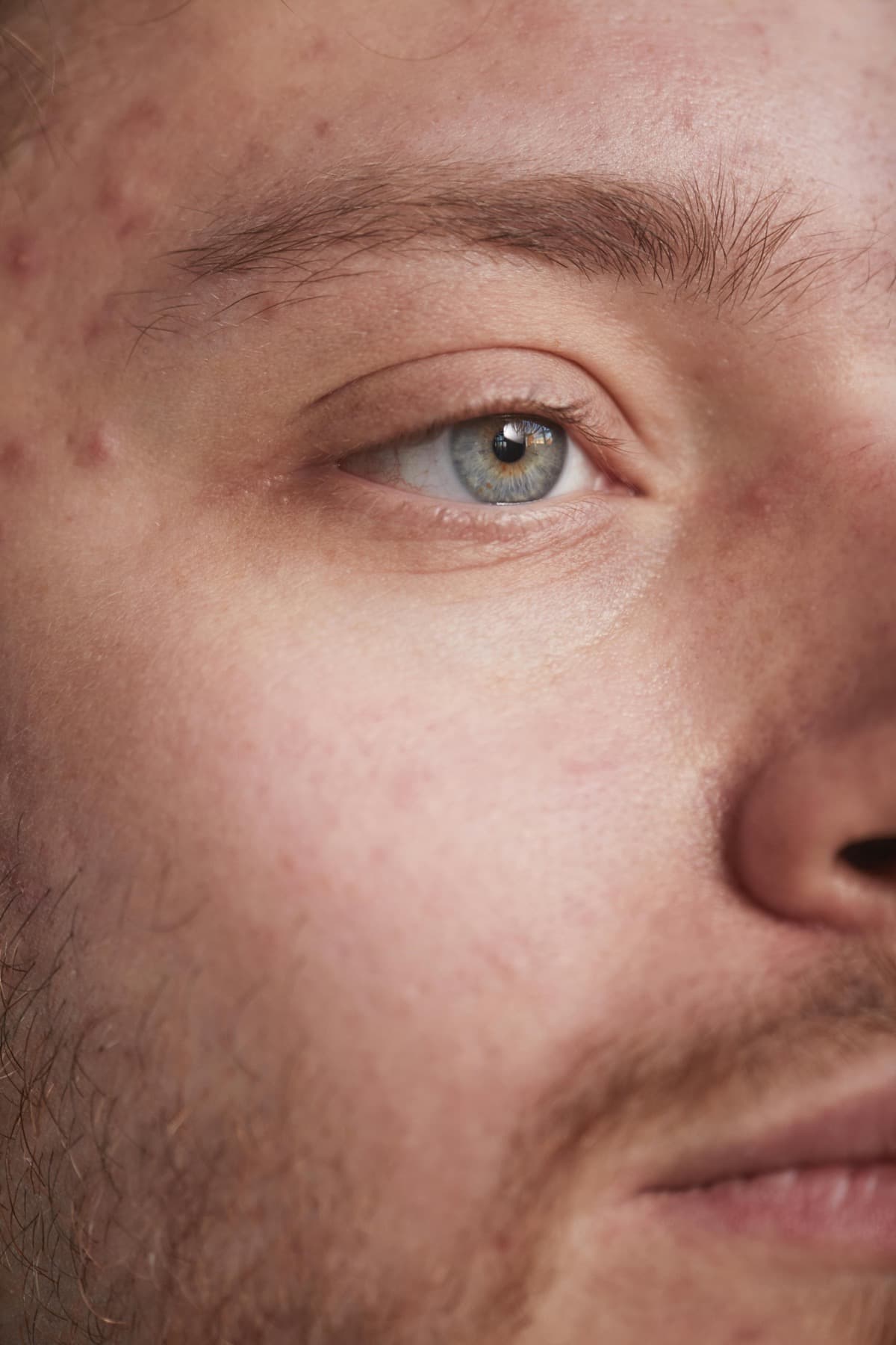 Acne Treatment at Nomi Beach Health -- Dermatology & Aesthetics