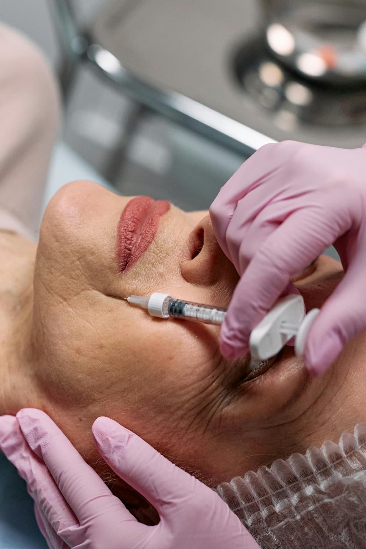 Nasolabial Fold Filler at Nomi Beach Health -- Dermatology & Aesthetics